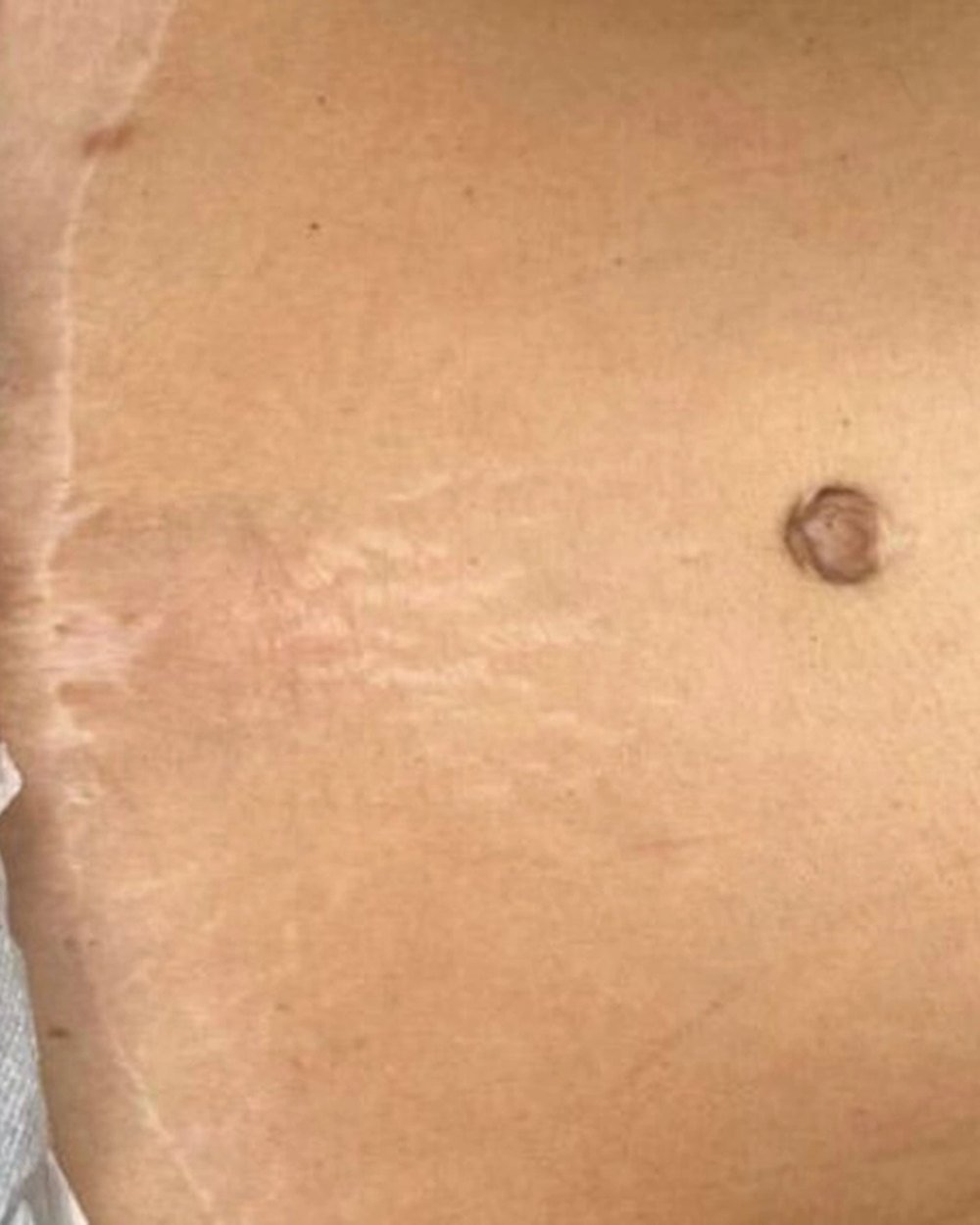 Cicatriz de abdominoplastia, antes do tratamento