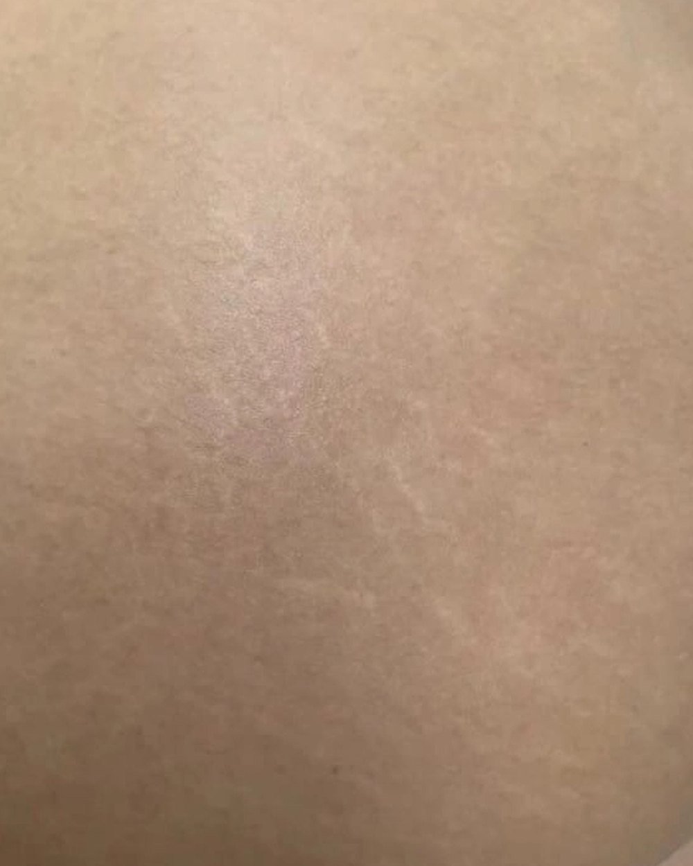 Estrias no glúteo, depois do tratamento